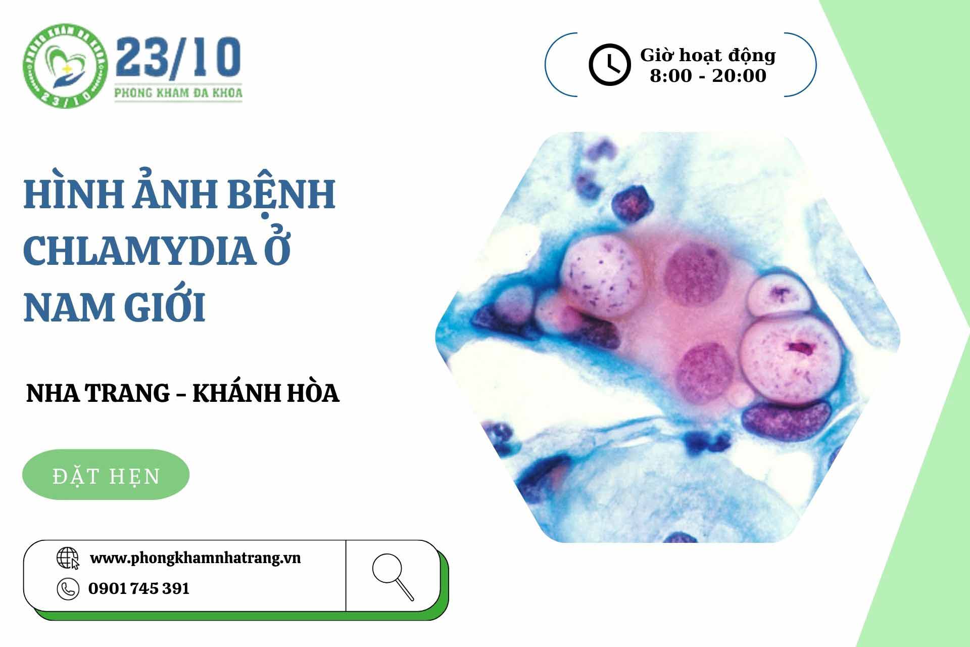 Hình ảnh chlamydia ở nam giới