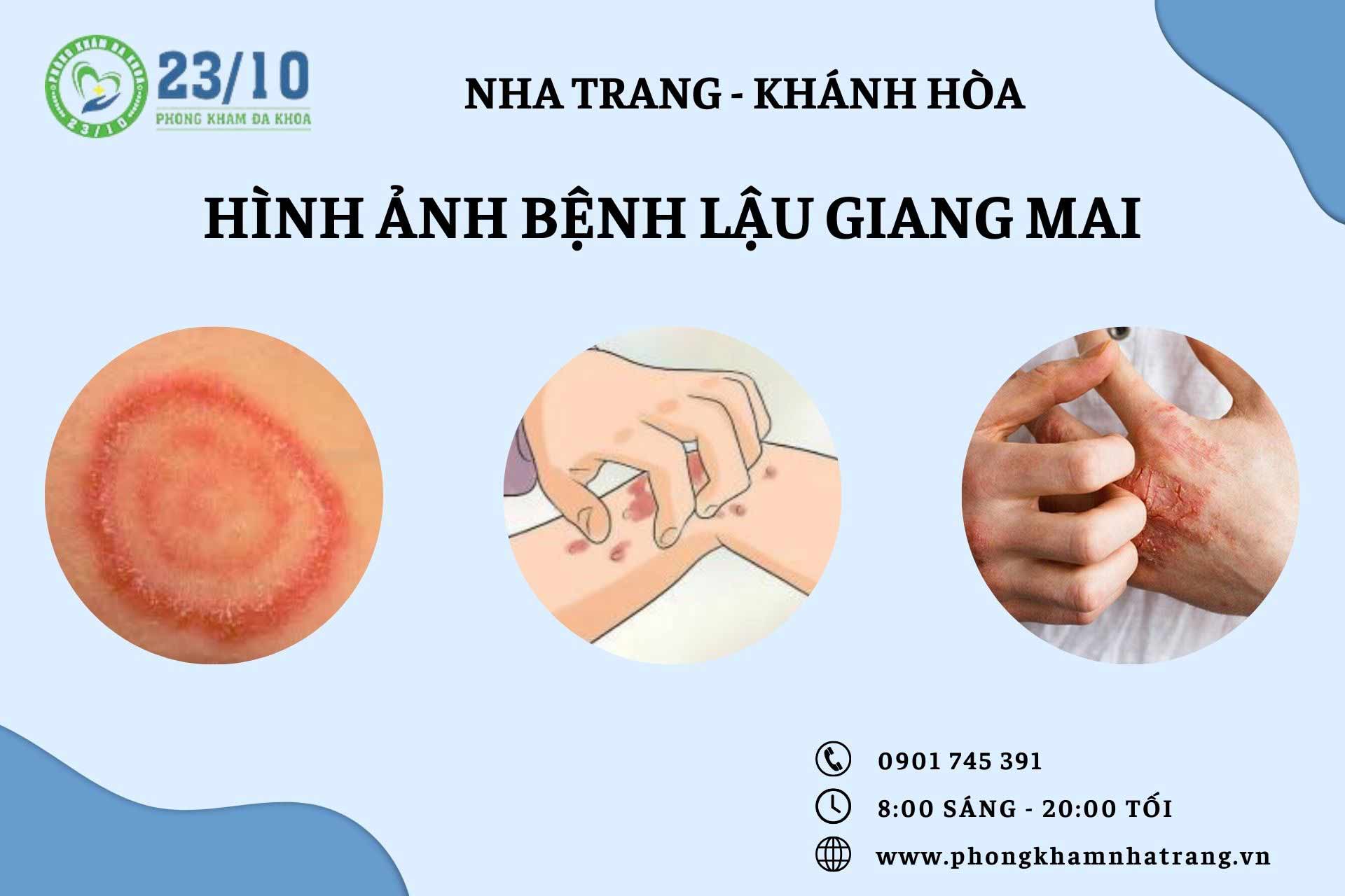 Hình ảnh bệnh lậu giang mai