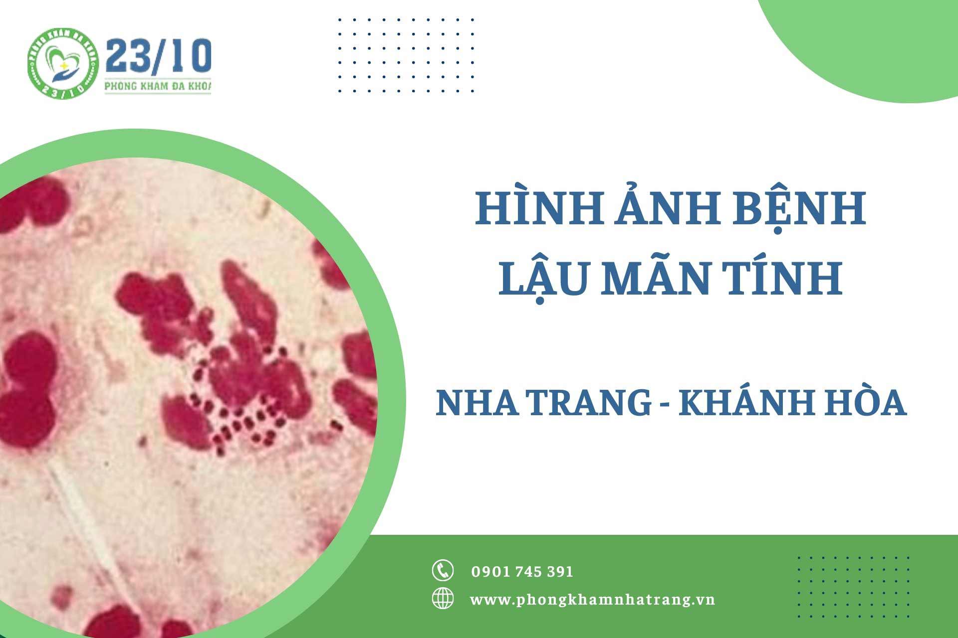Hình ảnh bệnh lậu mãn tính