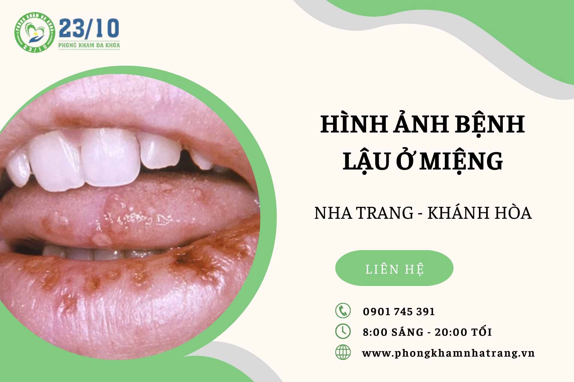 Hình ảnh bệnh lậu ở miệng
