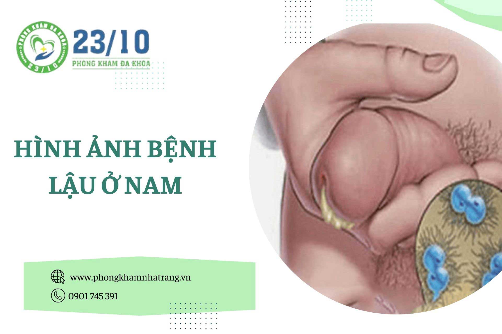 Hình ảnh bệnh lậu ở nam