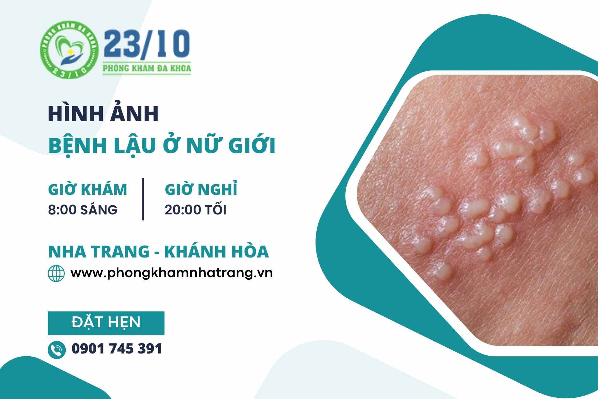 Hình ảnh bệnh lậu ở nữ giới