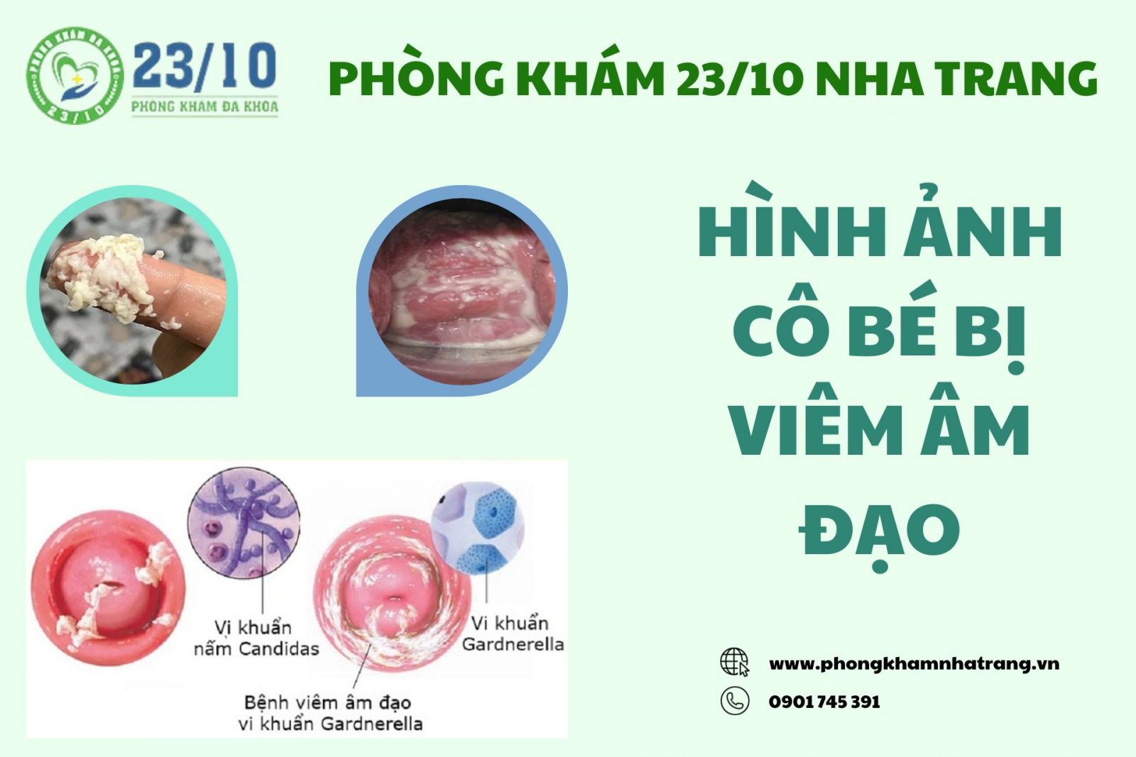 Hình ảnh cô bé bị viêm âm đạo