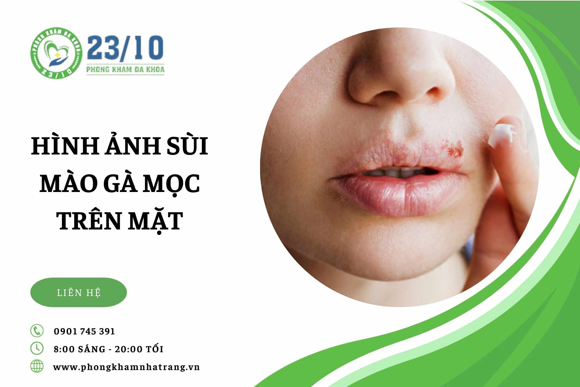 Hình ảnh sùi mào gà mọc trên mặt