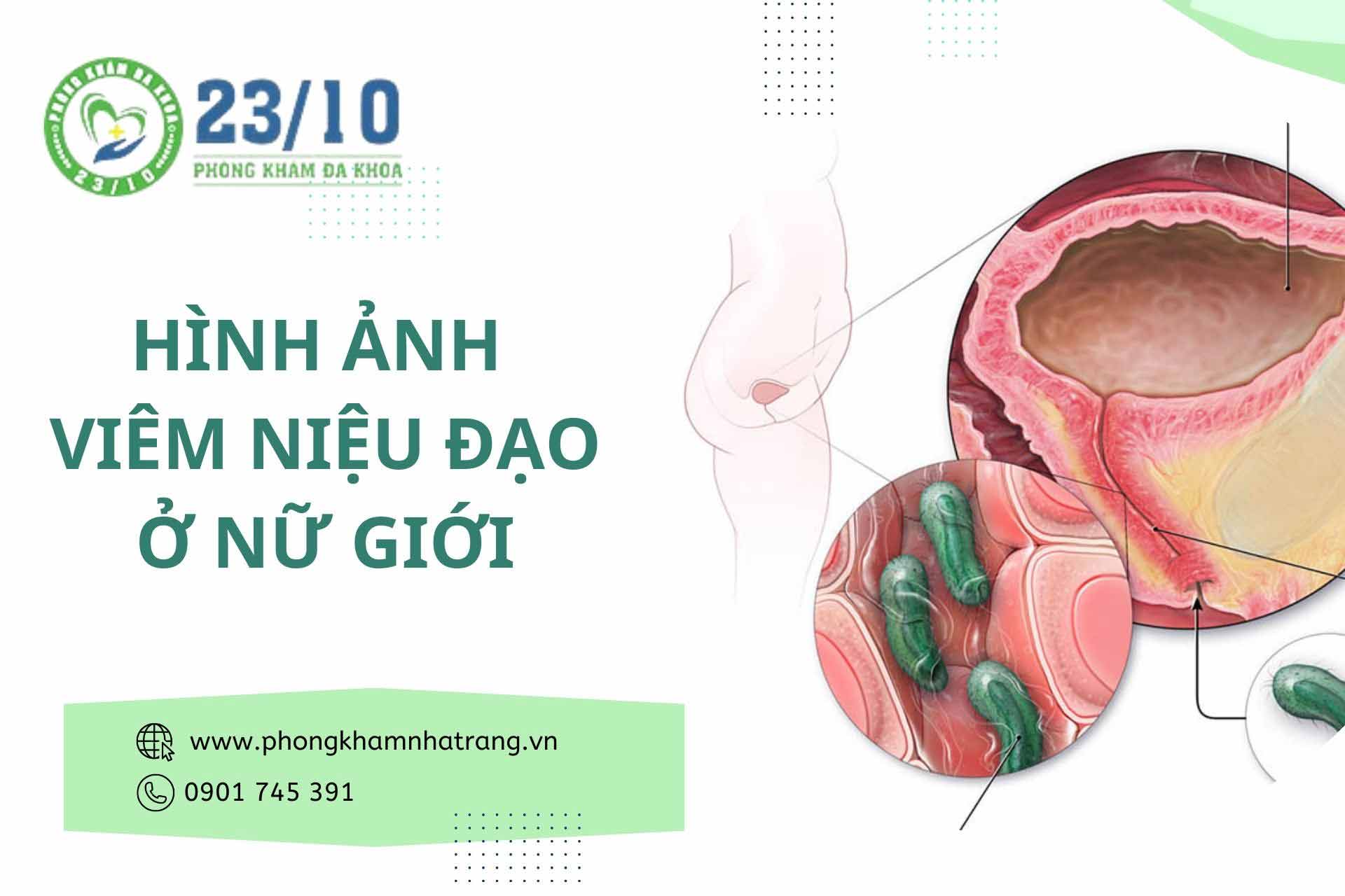 Hình ảnh viêm niệu đạo ở nữ