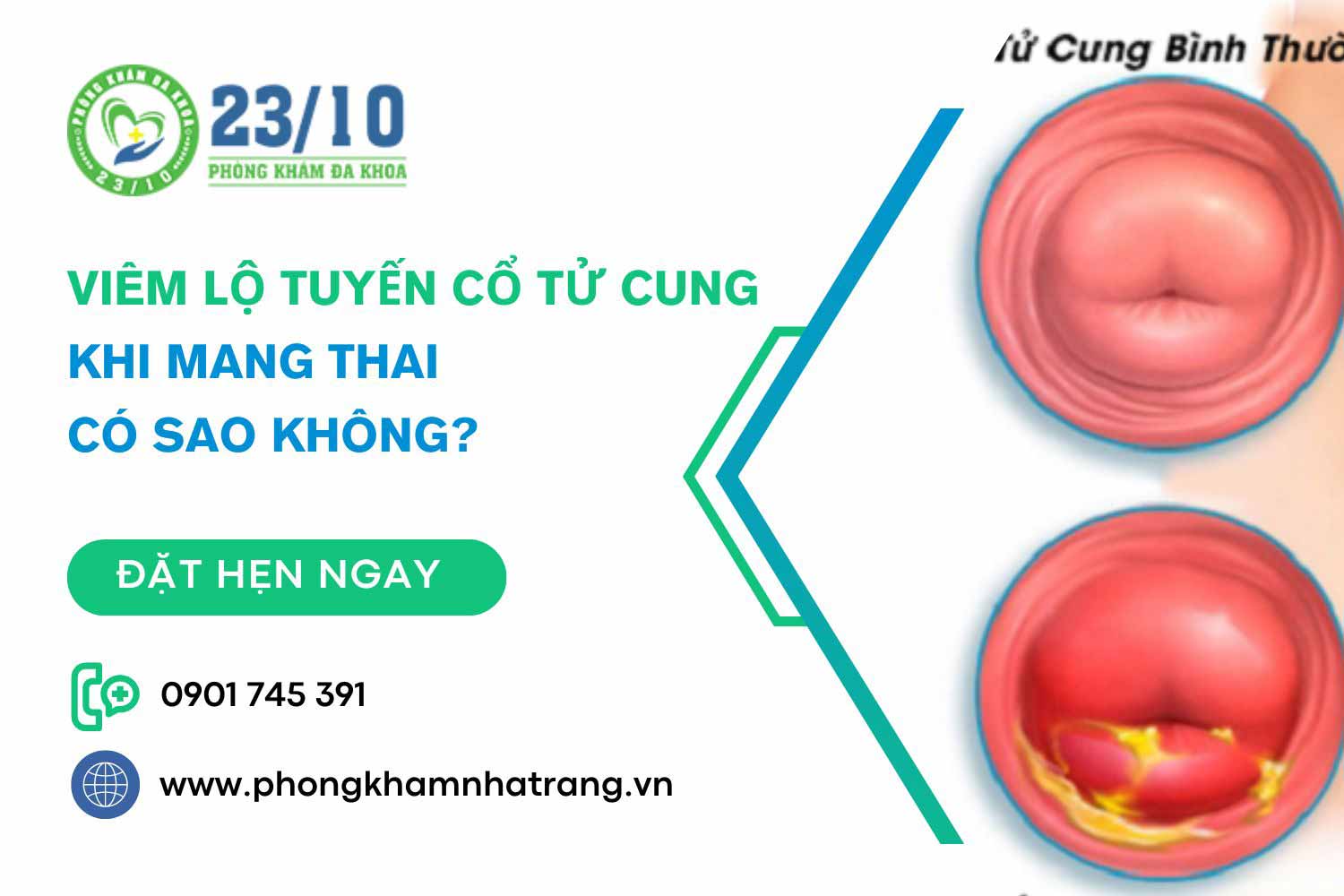 Bị viêm lộ tuyến cổ tử cung khi đang mang thai có sao không?