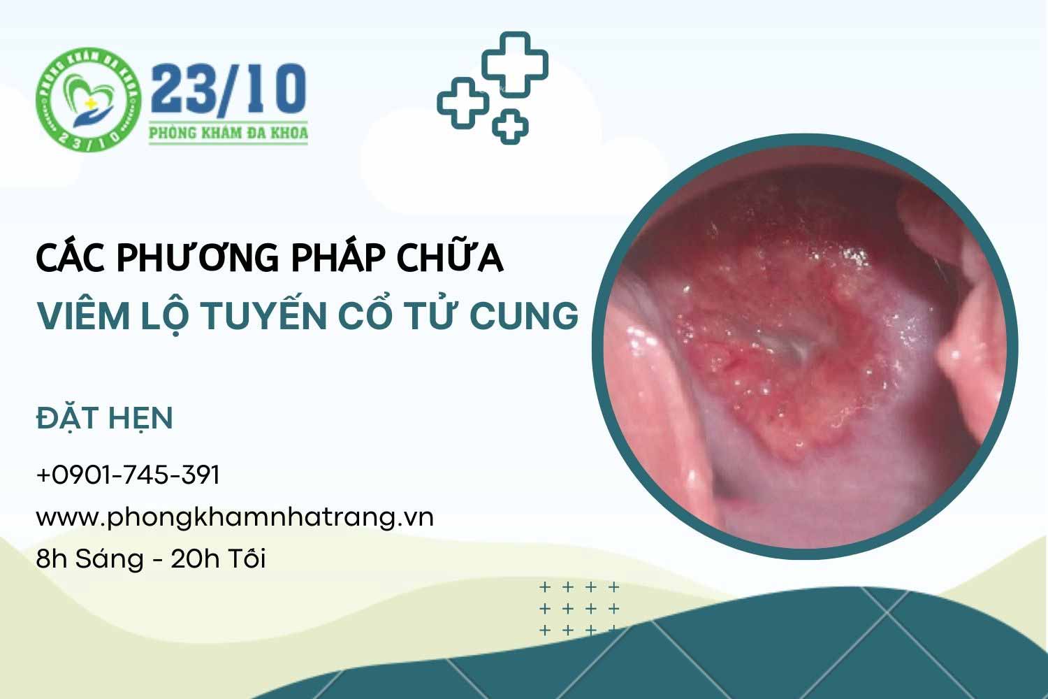 Các phương pháp chữa bệnh viêm lộ tuyến cổ tử cung