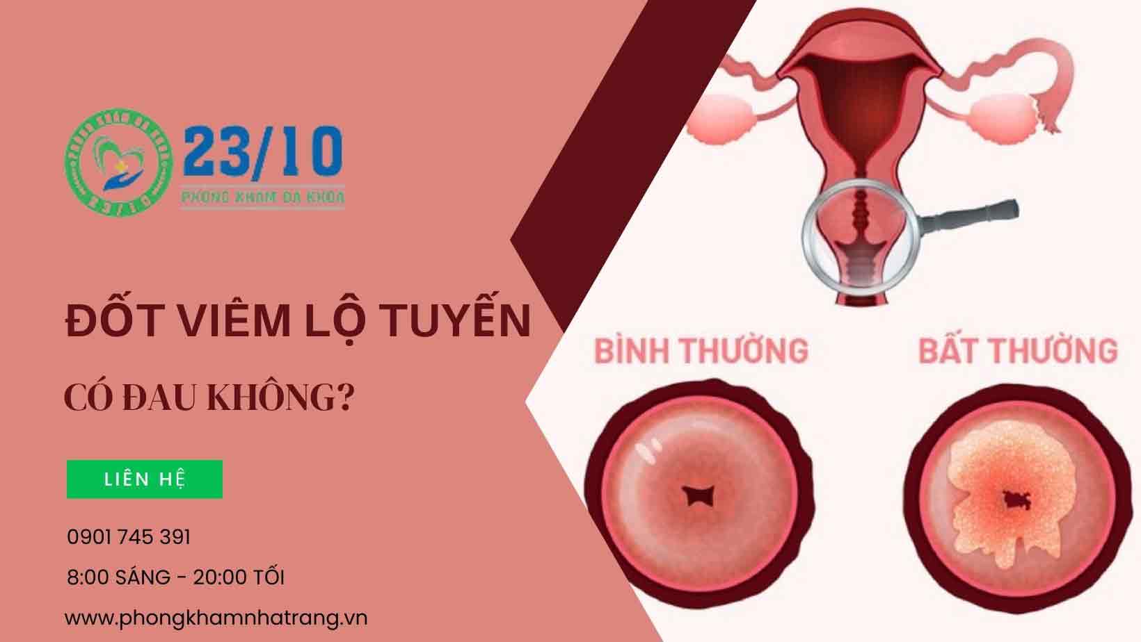 Hình ảnh khi đốt viêm lộ tuyến