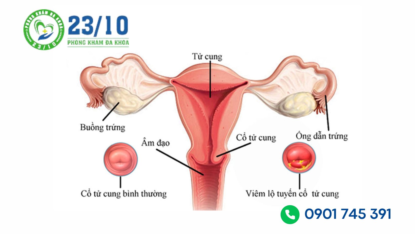 Hình ảnh sau khi đốt viêm lộ tuyến