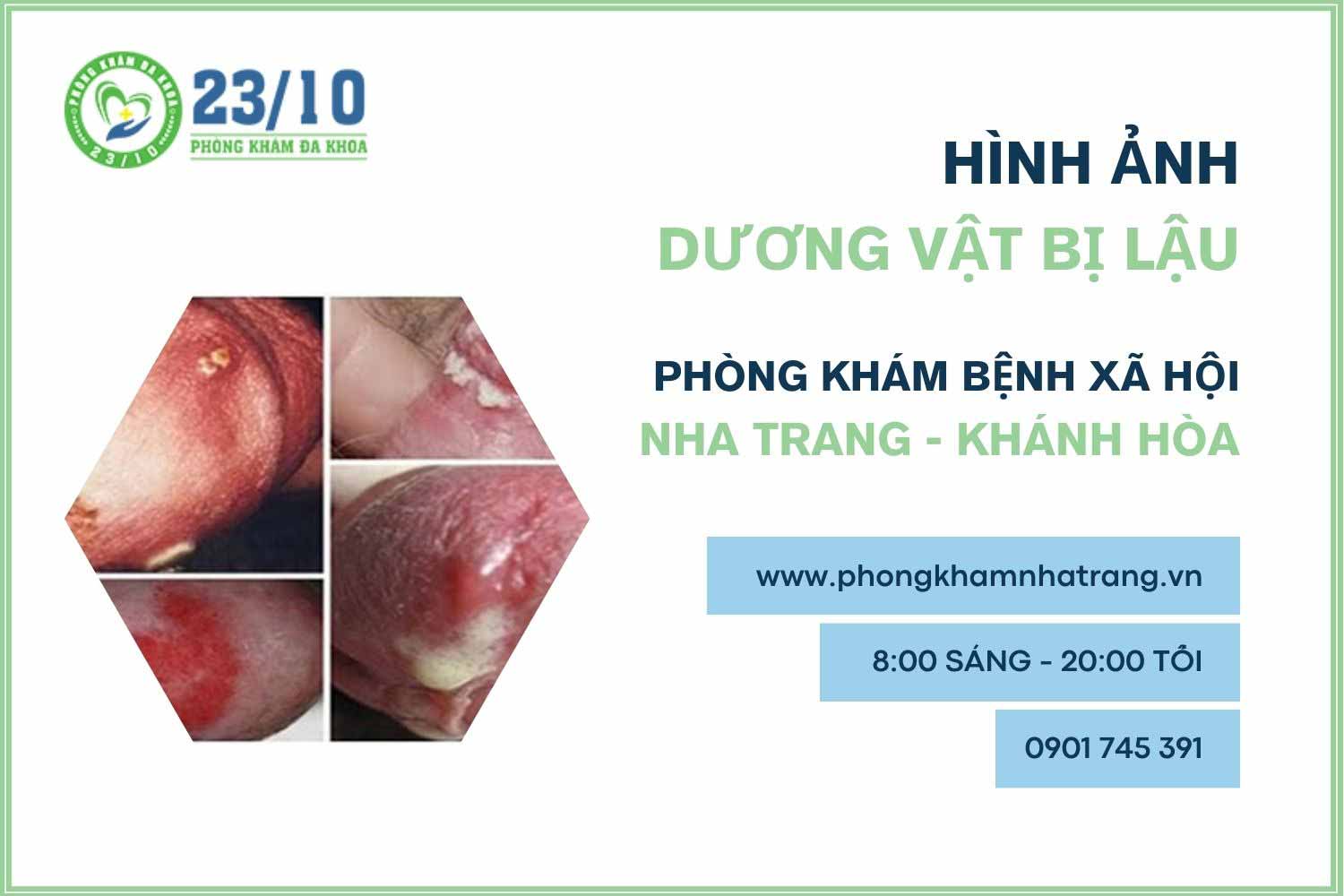 Hình ảnh mô tả bệnh lậu ở dương vật