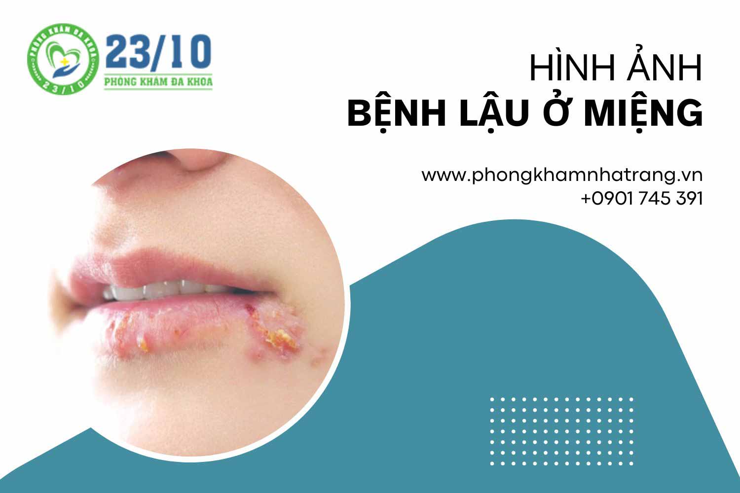 Hình ảnh mô tả bệnh lậu ở miệng