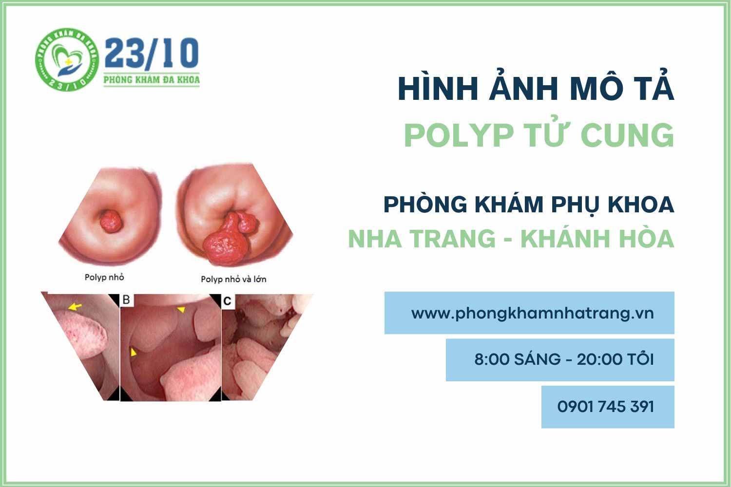 Hình ảnh mô tả bệnh polyp tử cung ở nữ giới