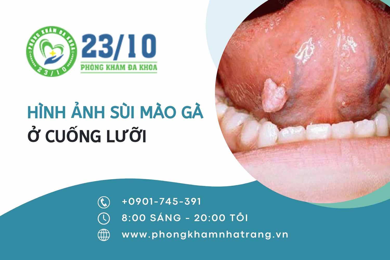 Hình ảnh bệnh sùi mào gà ở cuống lưỡi