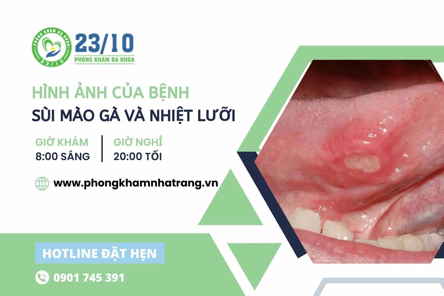 Hình ảnh của bệnh sùi mào gà và nhiệt lưỡi