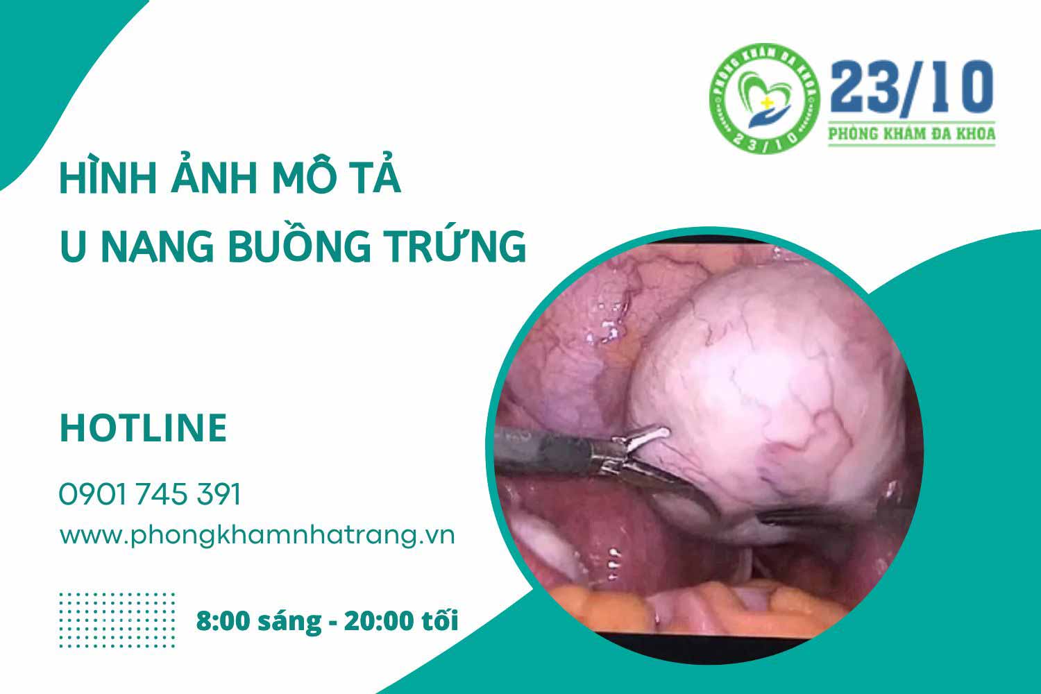 Hình ảnh mô tả bệnh u nang buồng trứng ở nữ giới