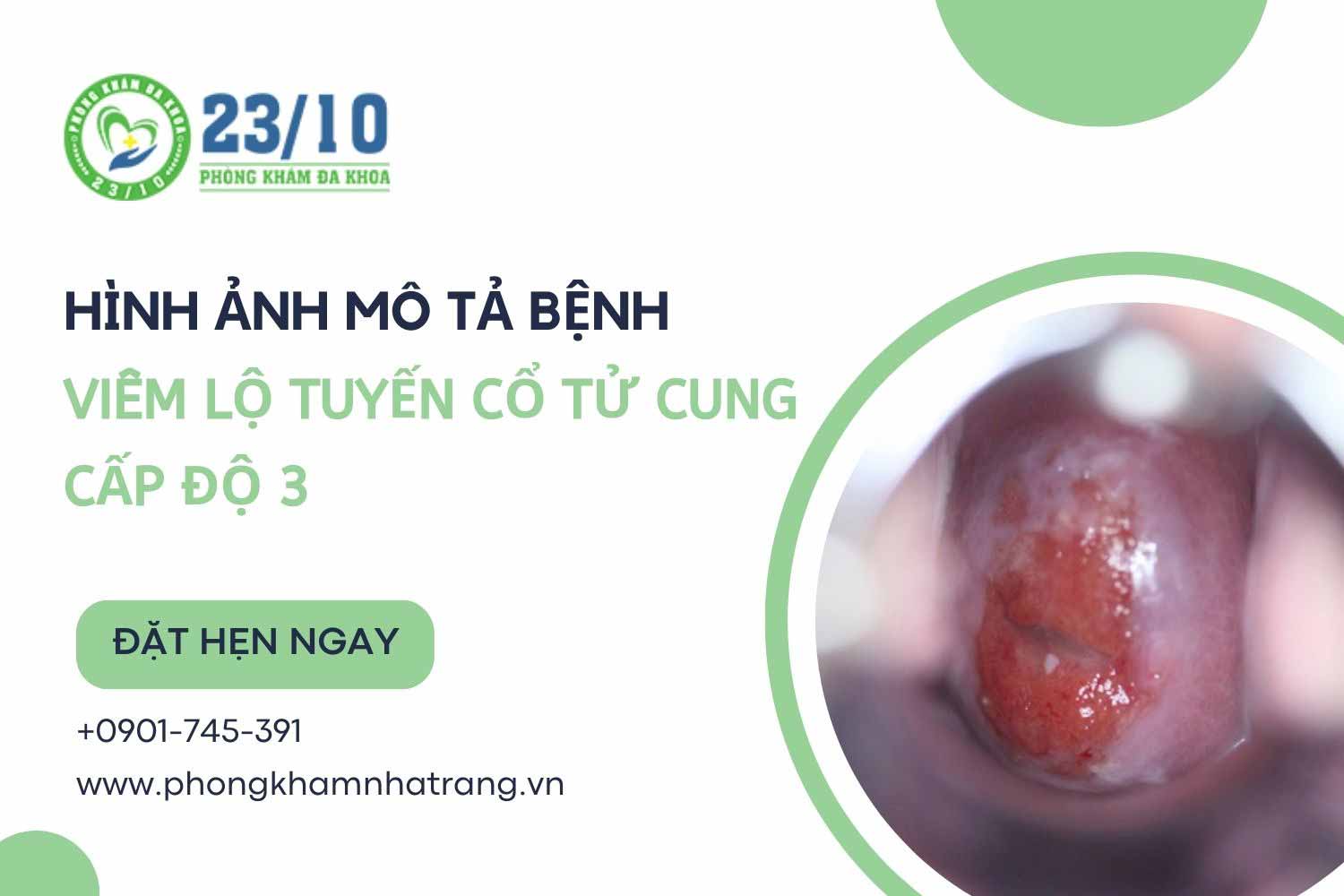 Hình ảnh mô tả bệnh viêm lộ tuyến cổ tử cung cấp độ 3