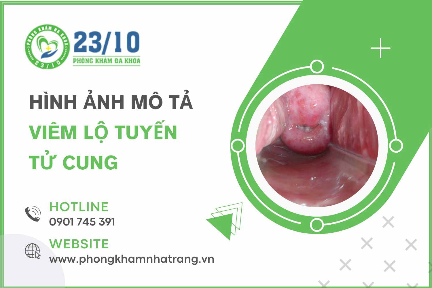 Hình ảnh mô tả bệnh viêm lộ tuyến tử cung ở nữ giới