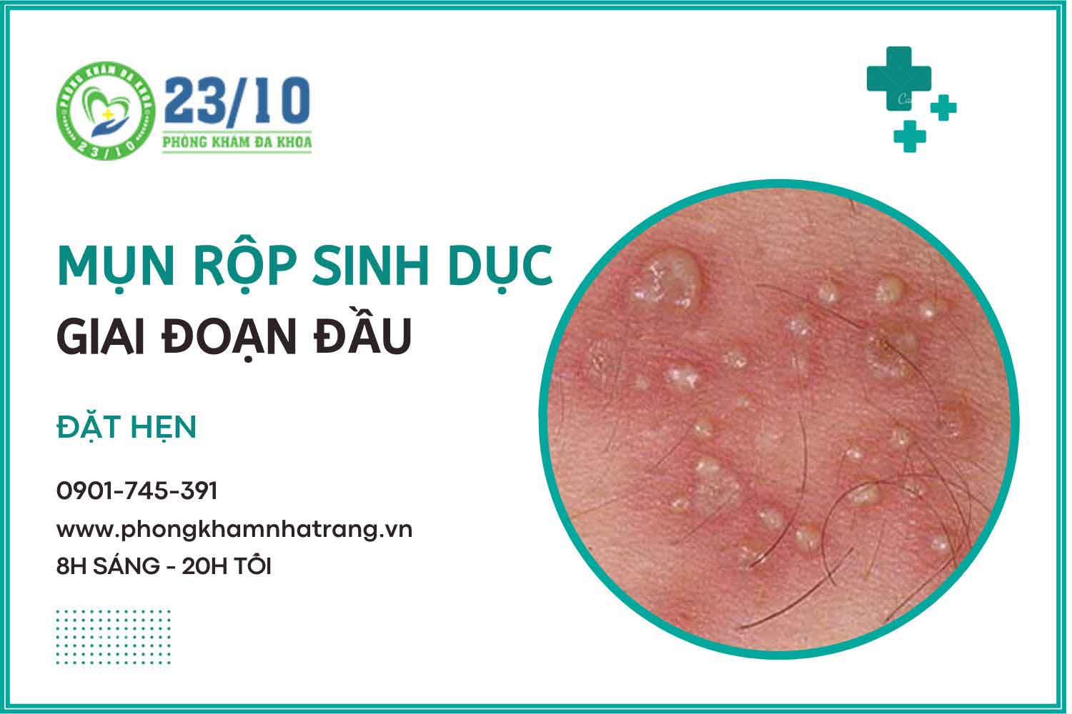 hình ảnh mô tả bệnh mụn rộp sinh dục ở giai đoạn đầu