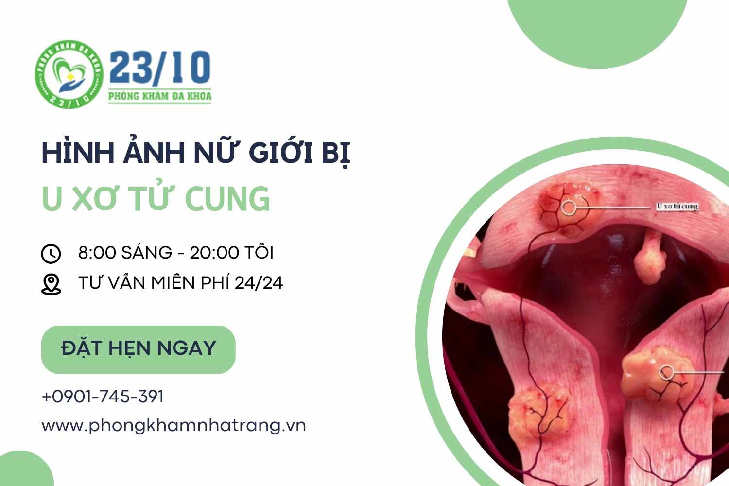 Hình ảnh mô tả tình trạng bệnh u xơ tử cung ở nữ giới