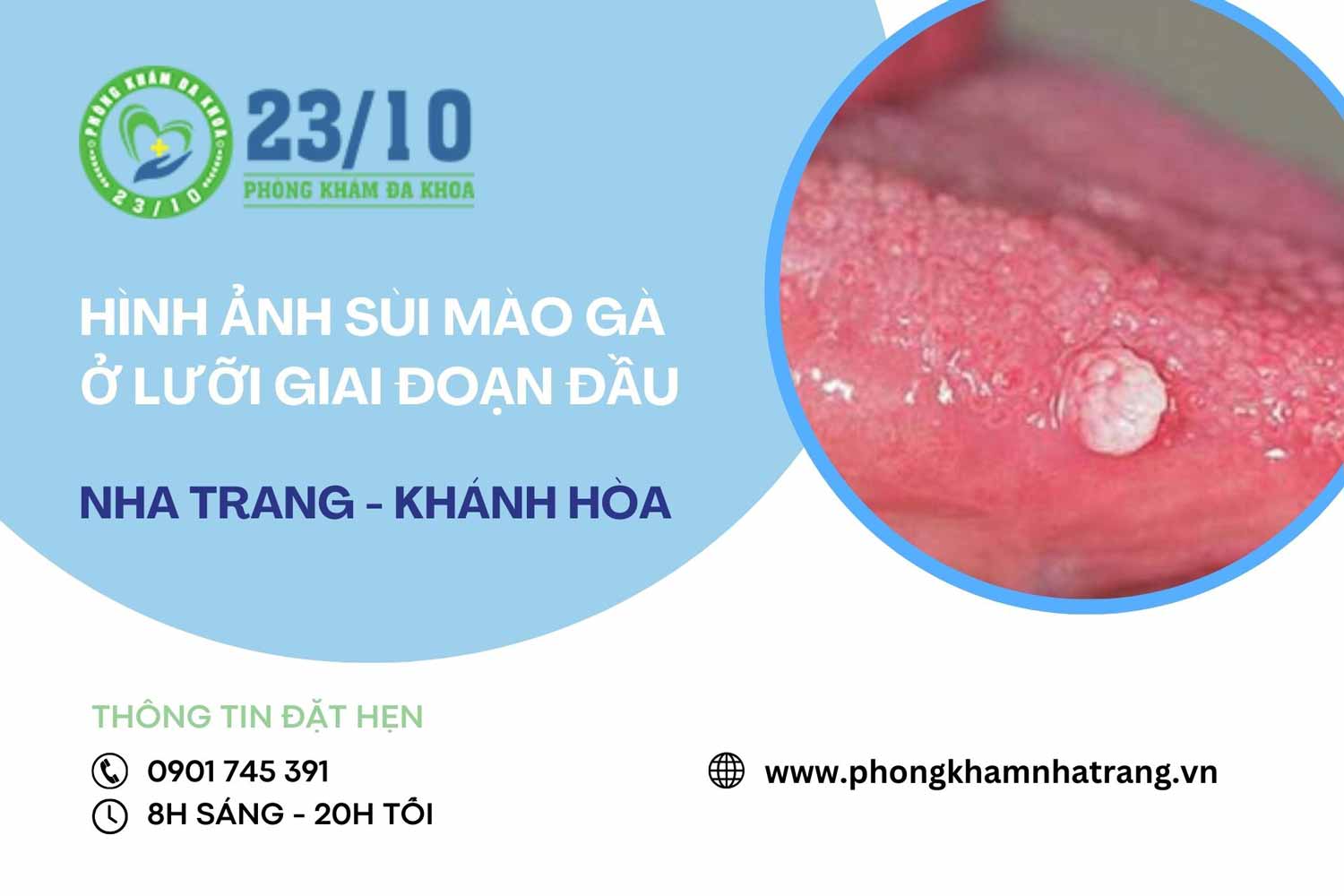 Hình ảnh sùi mào gà ở lưỡi giai đoạn đầu