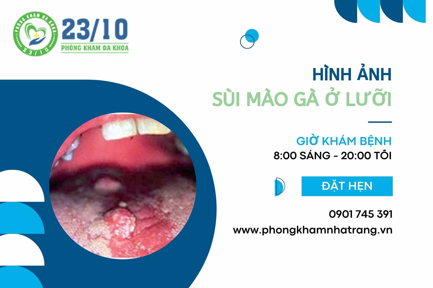 Hình ảnh sùi mào gà ở lưỡi