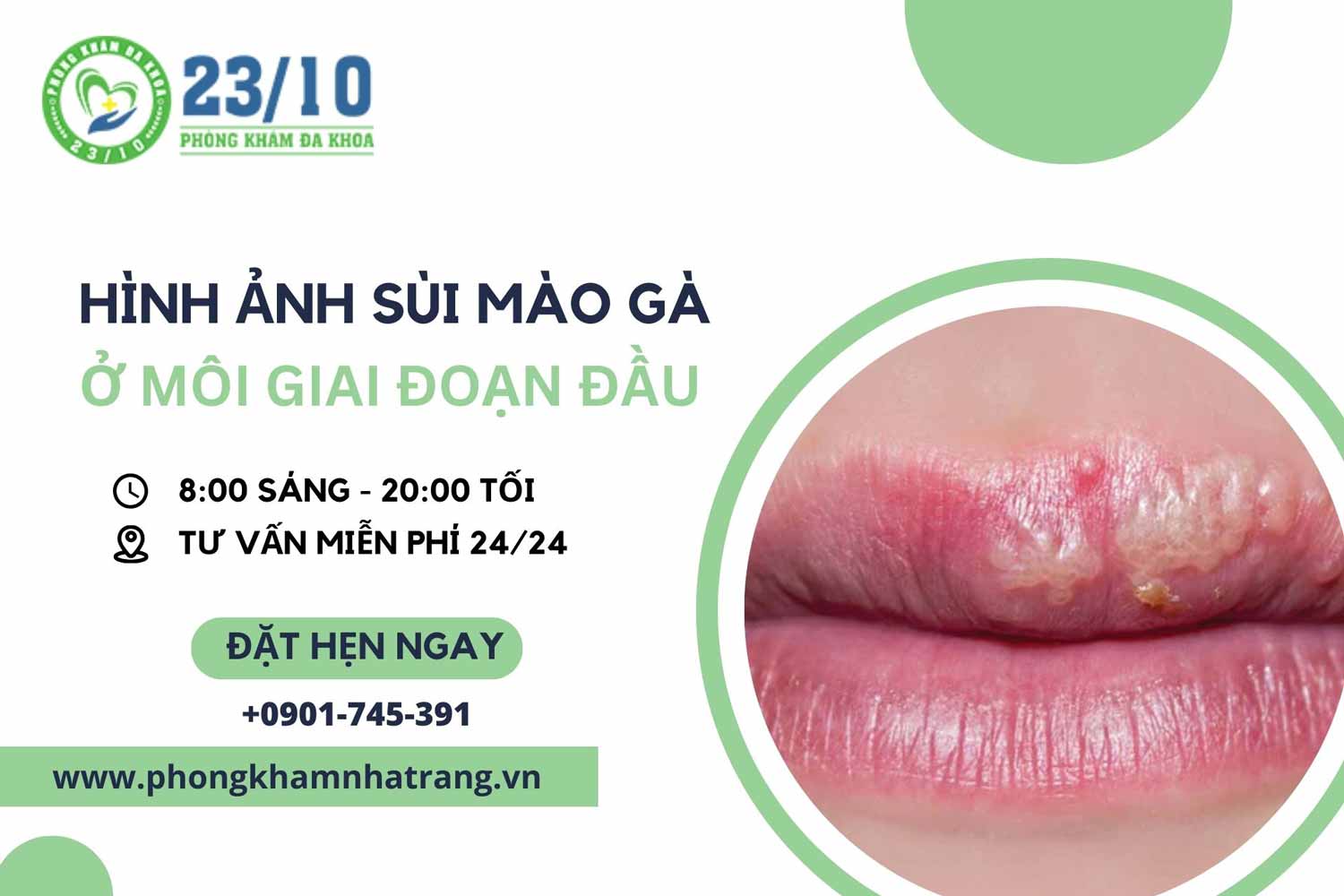 Hình ảnh sùi mào gà ở môi giai đoạn đầu sẽ như thế nào?