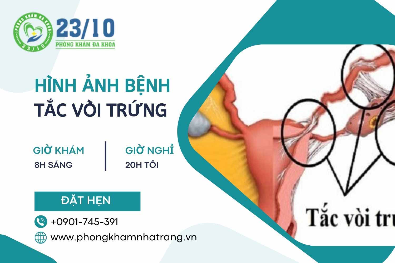 Hình ảnh mô tả bệnh tắc vòi trứng ở nữ giới