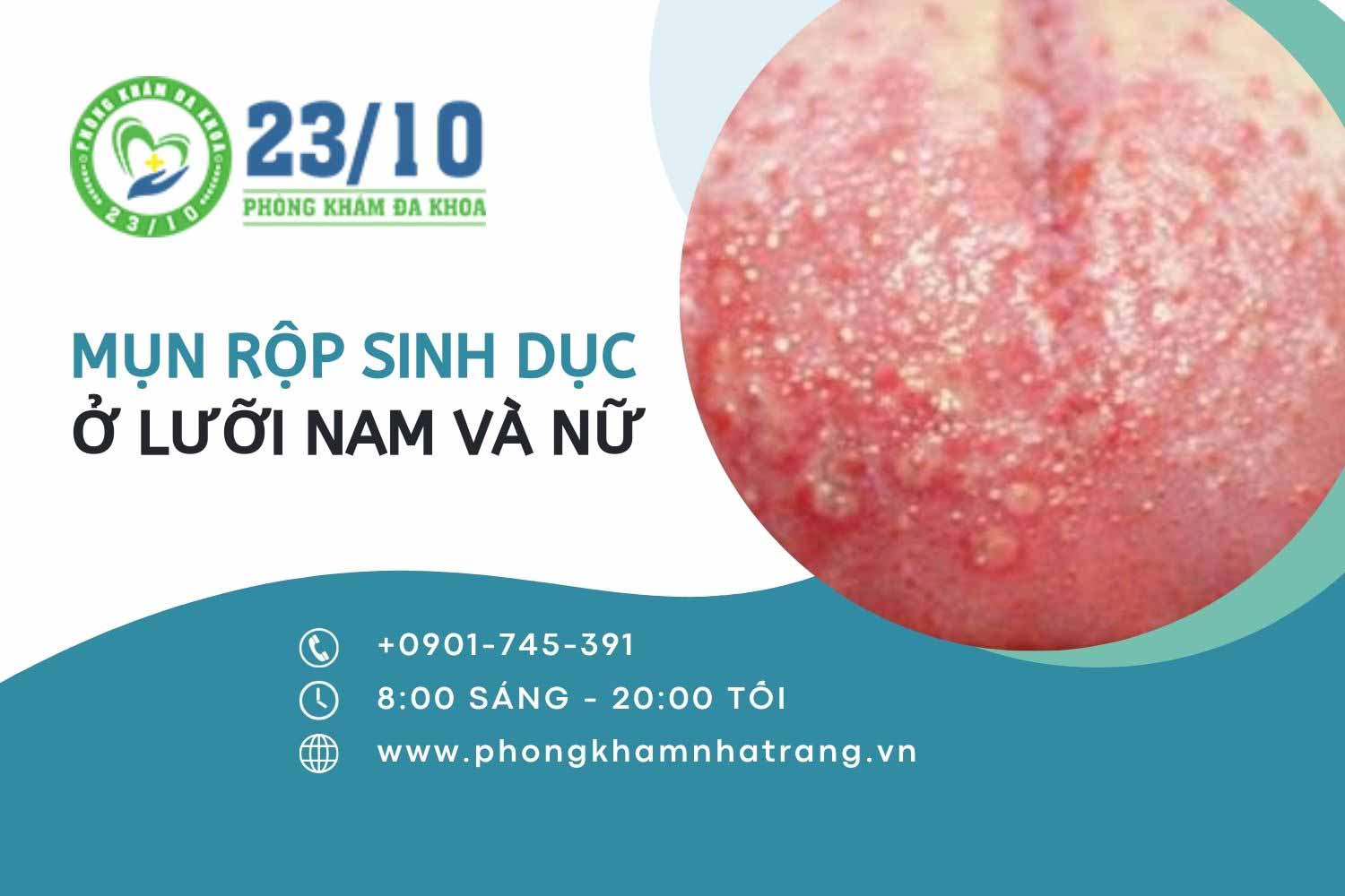 Mụn rộp sinh dục ở lưỡi