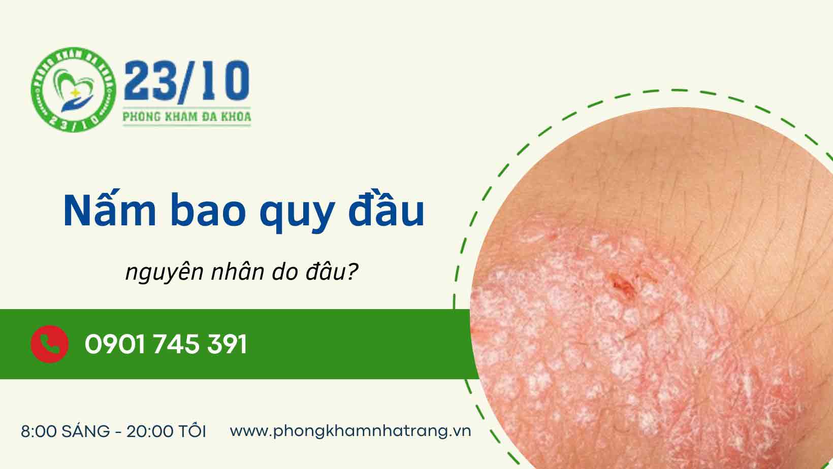 Nguyên do gây ra tình trạng nấm bao quy đầu