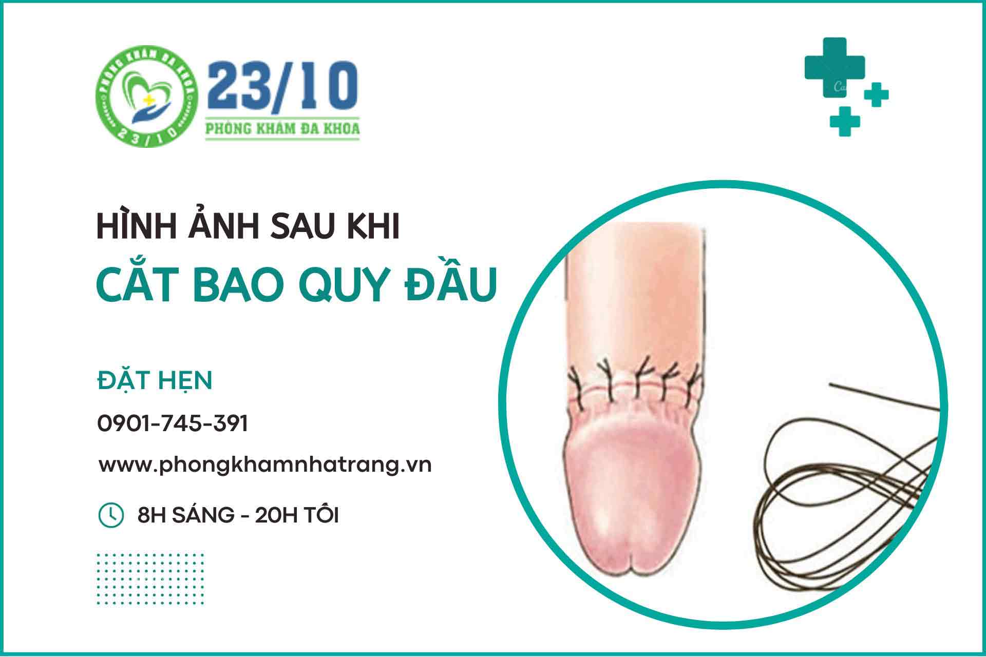 hình ảnh mô phỏng cho bao quy đầu sau khi được cắt