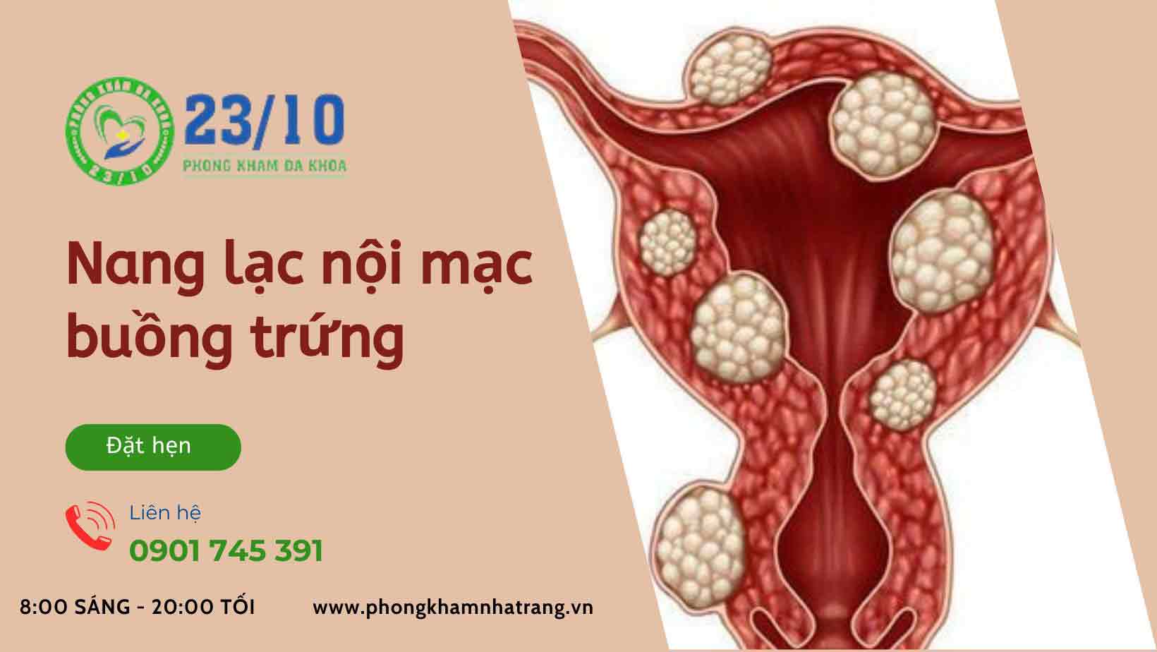 Nang lạc nội mạc buồng trứng trái và phải