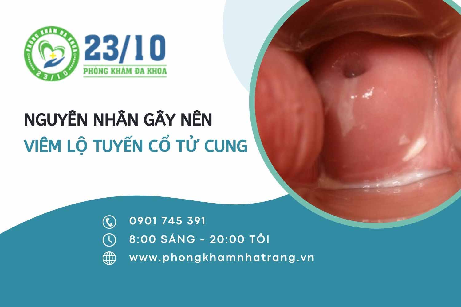 Nguyên nhân gây nên tình trạng viêm lộ tuyến cổ tử cung