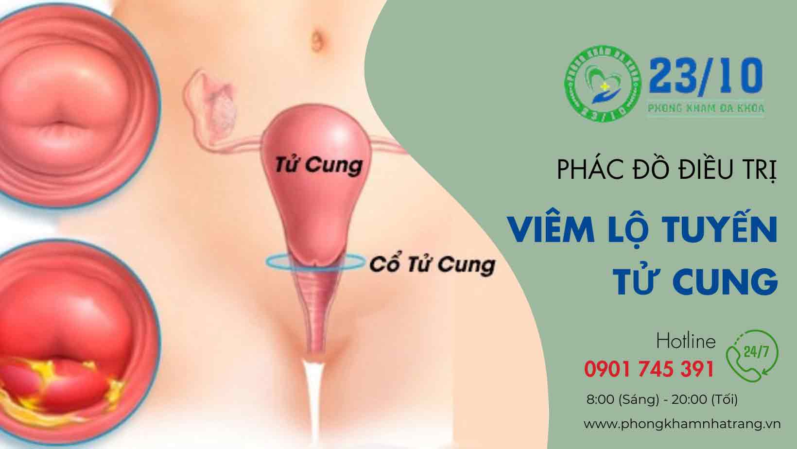 Hình ảnh bị viêm lộ tuyến tử cung