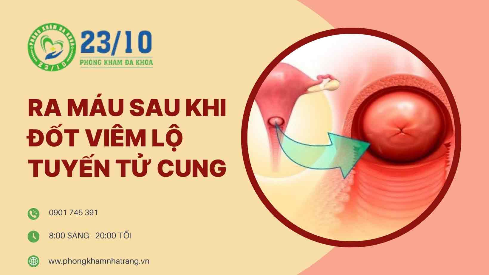 Hình ảnh viêm lộ tuyến tử cung