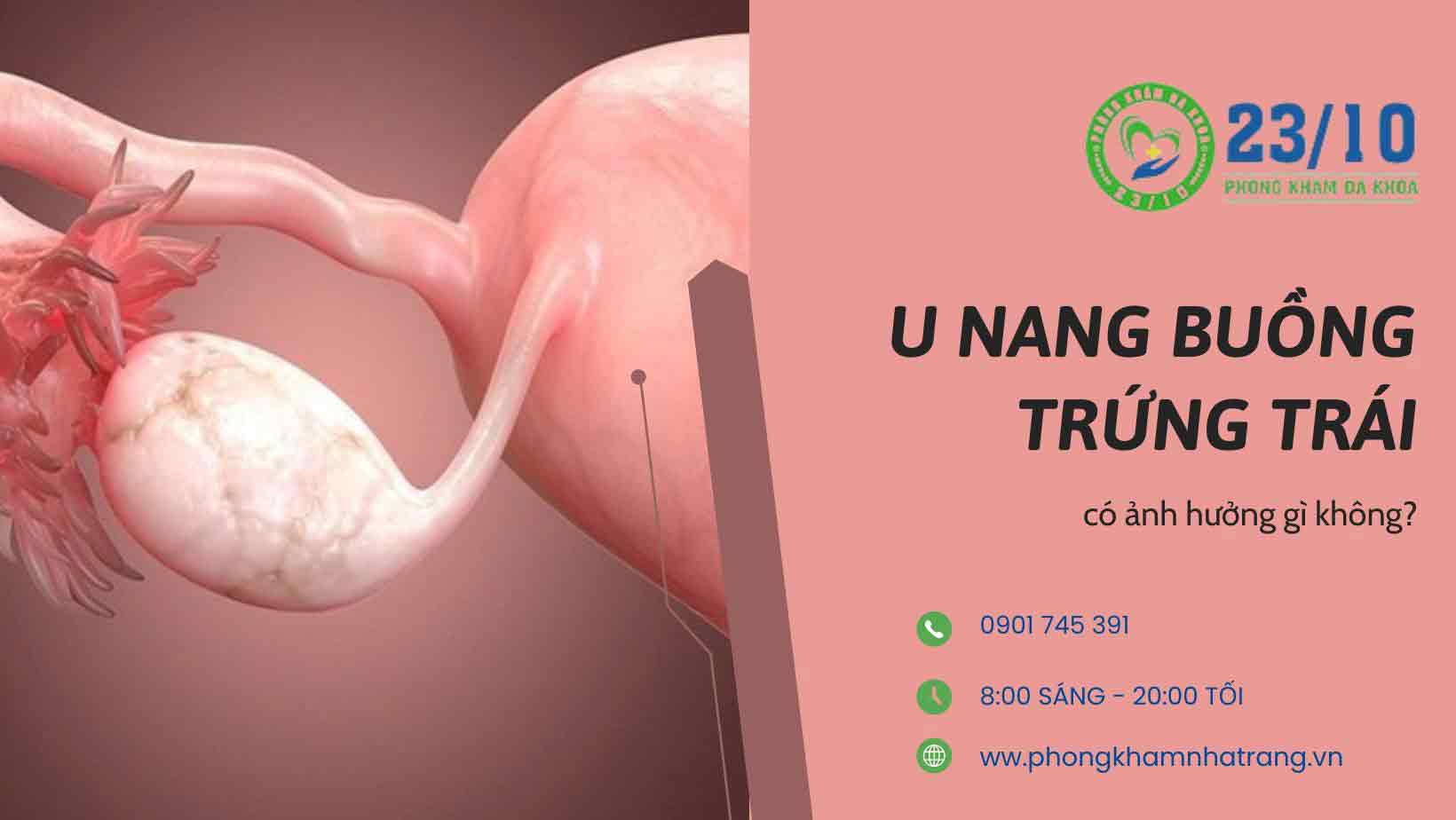 Dấu hiệu u nang buồng trứng trái