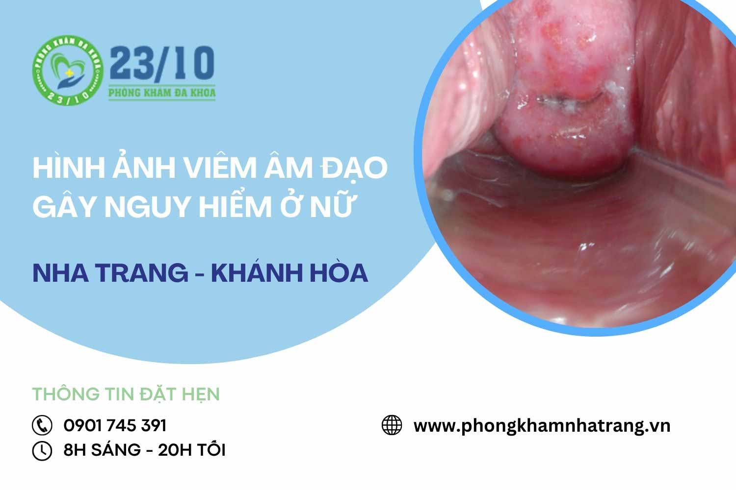 Hình ảnh miêu tả bệnh viêm âm đạo ở nữ giới