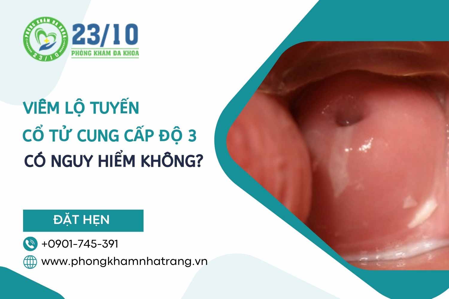 Bị viêm lộ tuyến cổ tử cung cấp độ 3 có nguy hiểm không?