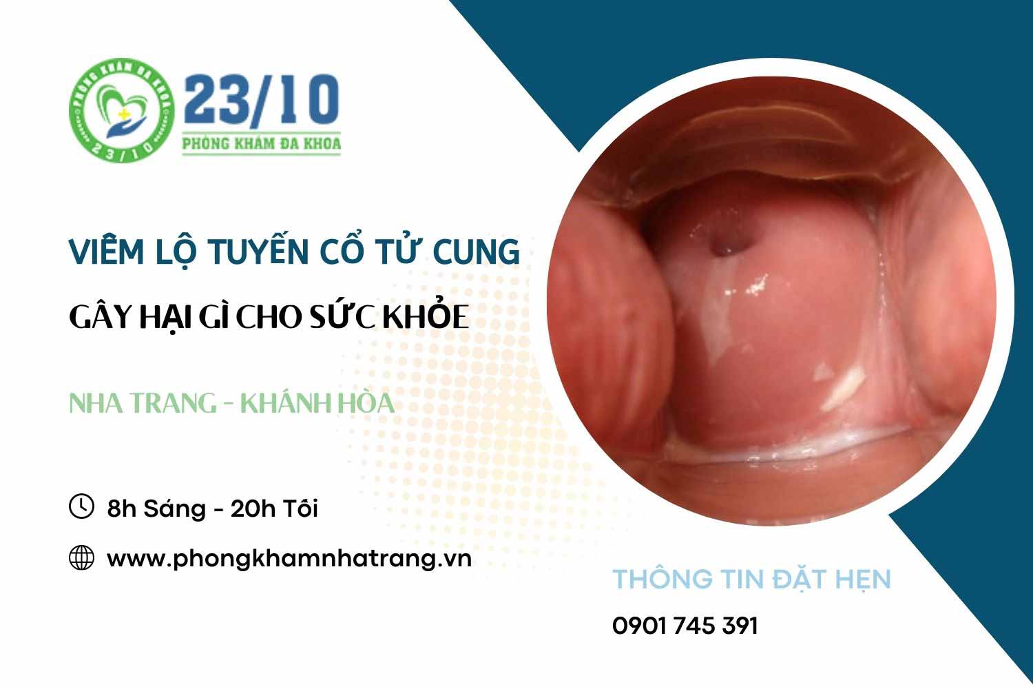 Viêm lộ tuyến cổ tử cung gây hại gì cho sức khỏe nữ giới