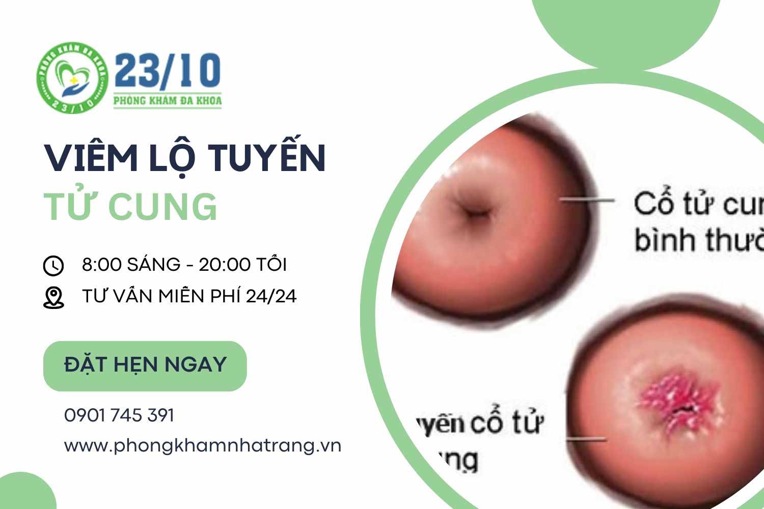 Hình ảnh viêm lộ tuyến tử cung ở nữ giới